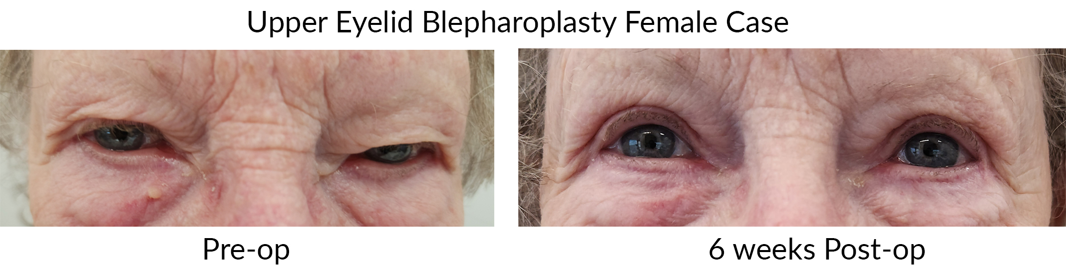 Case Example of Before and After Blepharoplasty