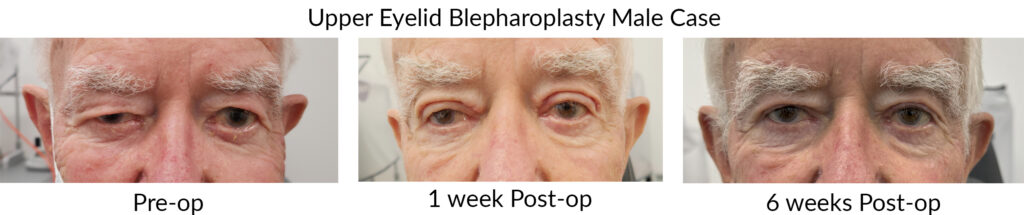 Another example of Upper Eyelid Blepharoplasty Surgery before and after surgery